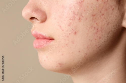 Teenage girl with acne problem on beige background, closeup photo