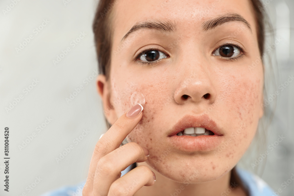 Teen girl applying acne healing patch, closeup Teen girl applying acne healing patch, closeup