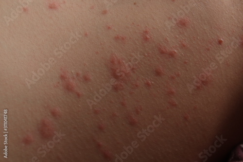 Close up of contact dermatitis rash and skin bumps in Caucasian skin as a result of an allergic reaction