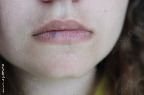lip hemangioma of the woman with mustache photo