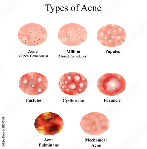 Types of Acne Skin inflammation. Pimples, boils, whitehead, closed comedones, papules, pustules, cystic acne. Infographics. Vector illustration on isolated background.