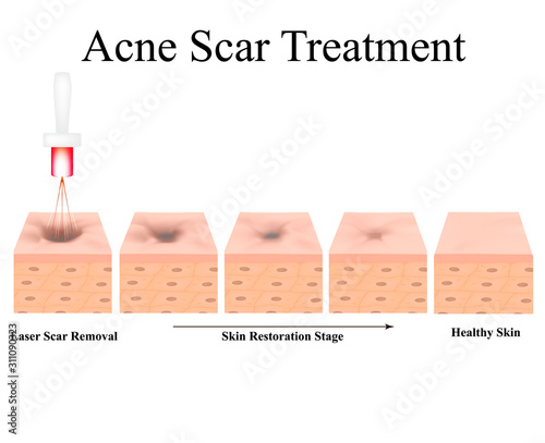 Acne scars. Laser scar atrophic treatment. The anatomical structure of the skin with acne. Vector illustration on isolated background.
