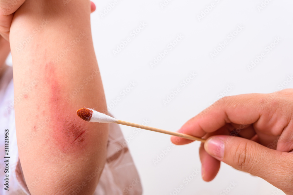 Asian boy kid show arm accident His mother washed the wound he painful abrasion scratches from fall Asian boy kid show arm accident His mother washed the wound he painful abrasion scratches from fall
