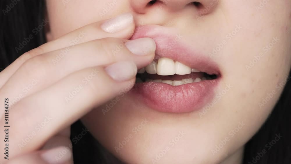 Girl smears ointment lips. Dry skin in the cold season. Disease and lack of vitamins. Girl smears ointment lips. Dry skin in the cold season. Disease and lack of vitamins.