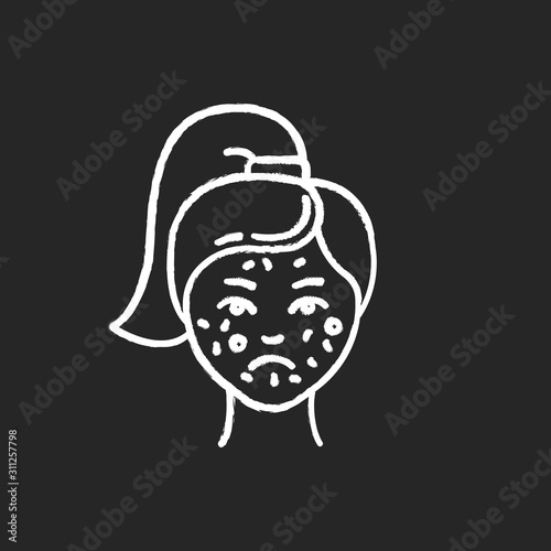 Acne chalk icon. Pimples on female face. Skincare for inflammation and irritation. Facial treatment. Puberty and teenager health problem. Dermatology. Isolated vector chalkboard illustration