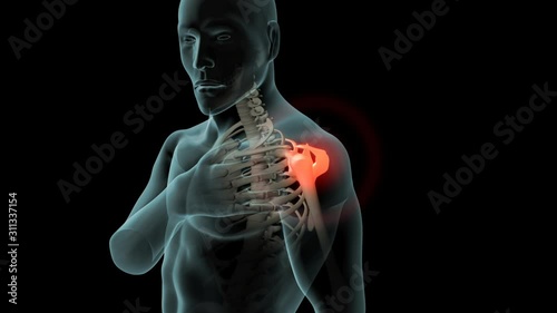 Shoulder Pain