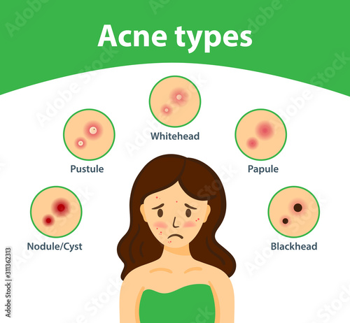 Acne types and sad girl with acne on face. Vector woman face. Skin care illustration.