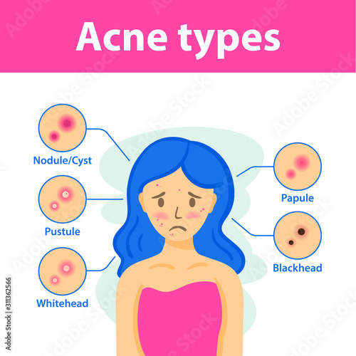 Acne types and sad girl with acne on face. Vector woman face. Skin care illustration.