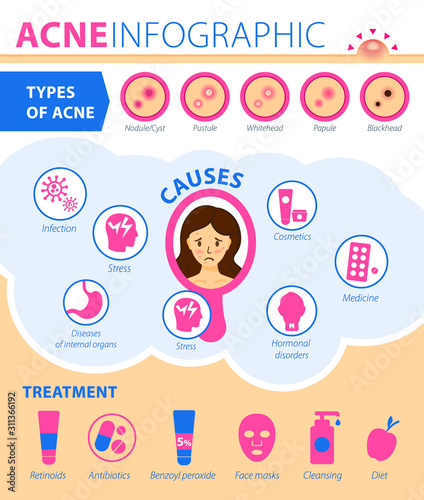 Types of acne, causes of the disease, treatment. Infographics of acne.