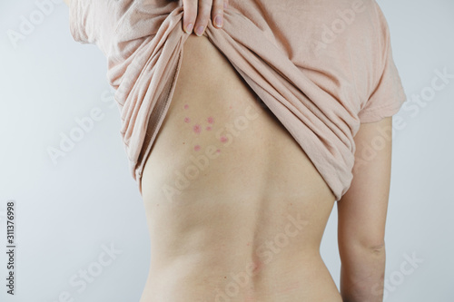 Damaged skin on female's back. Bedbug bites, moosquito bites or skin disease on human body photo