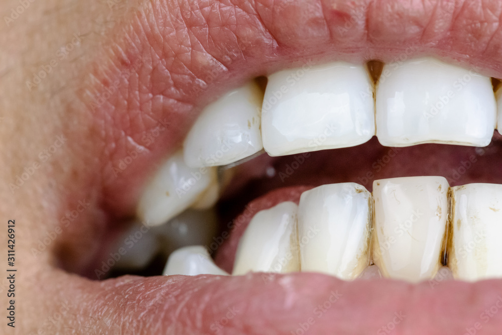 Obraz premium Close up of teeth stained by smoking and drinking coffee