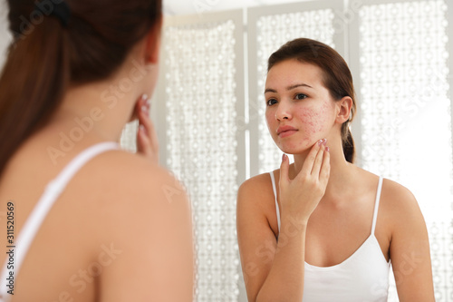 Obraz na plátně Teen girl with acne problem near mirror in bathroom