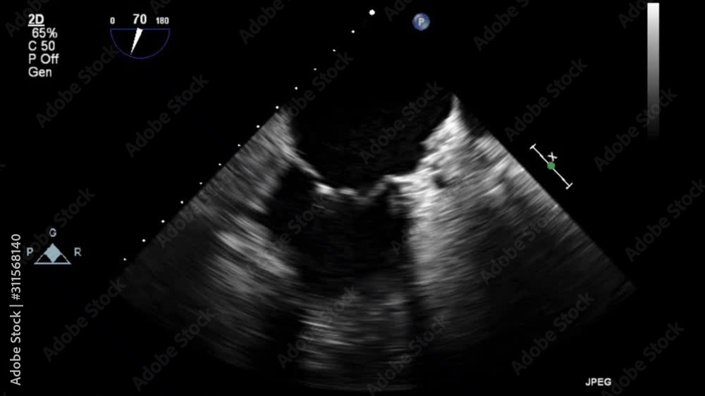 High quality transesophageal ultrasound video in gray-scale mode.