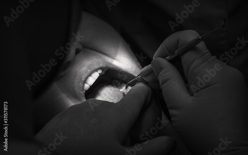 tdentistry. dental treatment, close-up. teeth and caries.