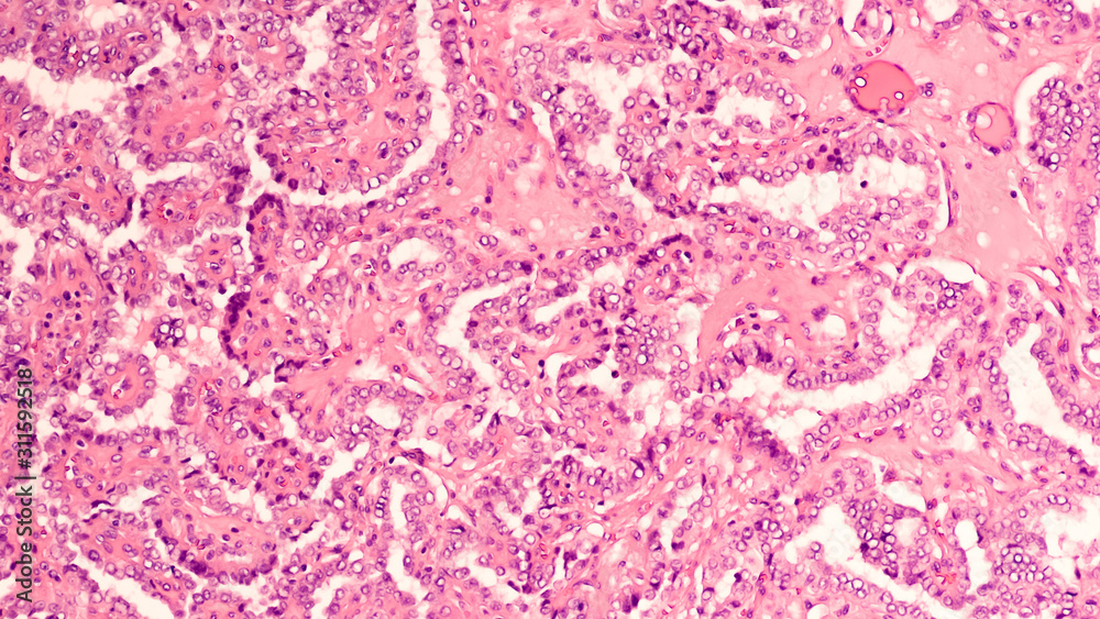 Thyroid gland cancer awareness: Microscopic image of papillary thyroid ...
