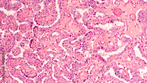Thyroid gland cancer awareness: Microscopic image of papillary thyroid carcinoma, characterized by branching papillae with fibrovascular cores 