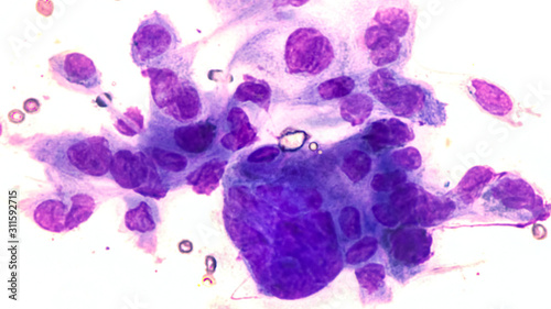 Cytology scraping of a skin lesion (Tzanck smear) showing characteristic multinucleated giant cells with molding in a patient with chicken pox (Varicella zoster virus (VZV), a type of herpes virus.   photo