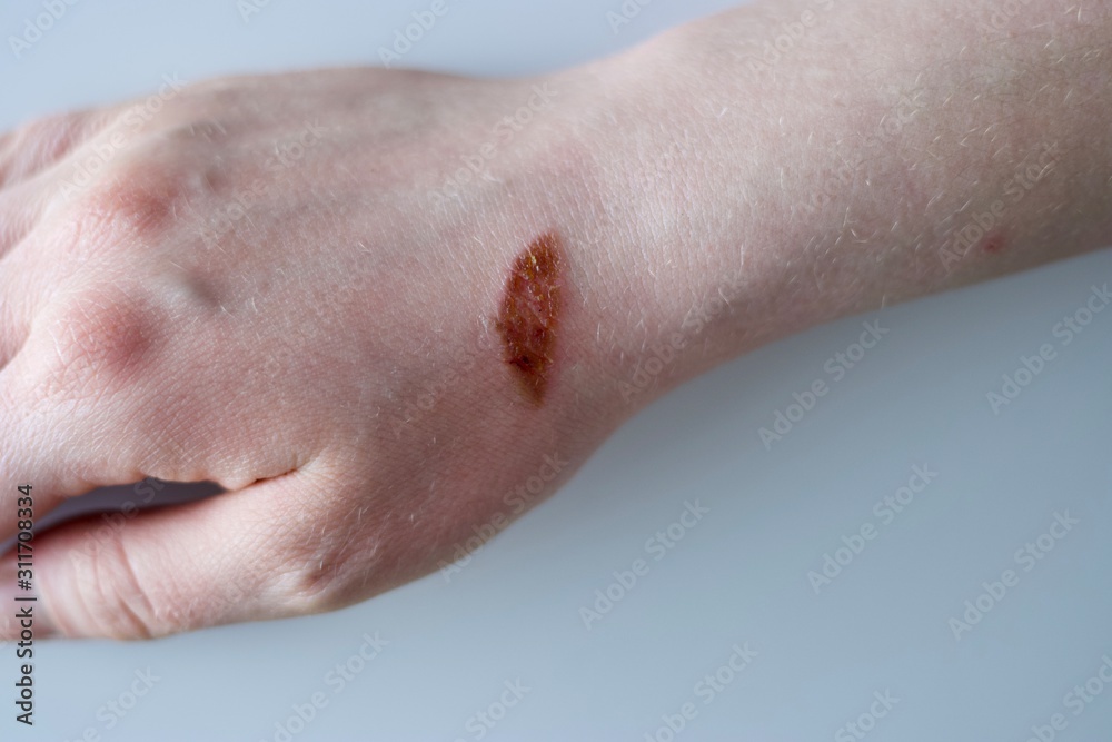 Nasty unpleasant burn on middle-aged white woman's wrist from carelessness from handling hot oven Nasty unpleasant burn on middle-aged white woman's wrist from carelessness from handling hot oven