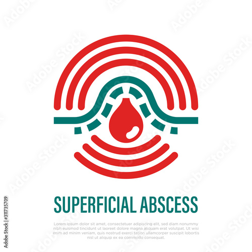 Superficial abscess thin line icon. Pus under skin, inflammation and pain. Furuncle, pustule, acne. Vector illustration.