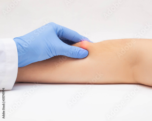 Doctor dermatologist examines the subcutaneous wen on the patient's arm, close-up. The concept of skin diseases, lipoma photo