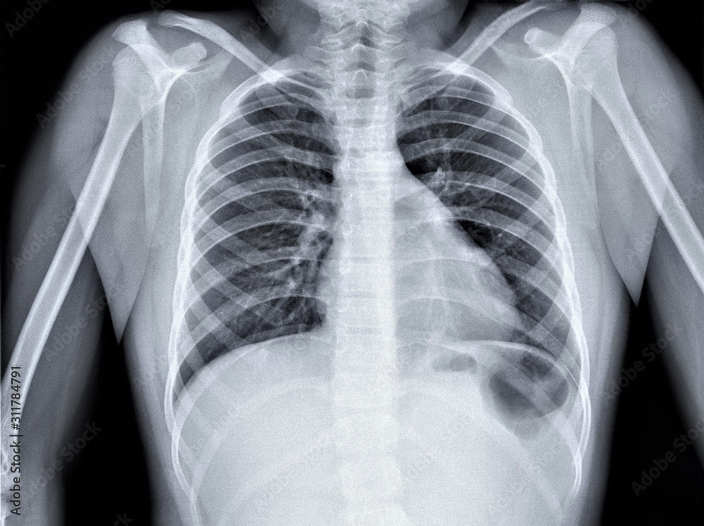 normal radiography of chest organs in direct projection, traumatology and orthopedics, pulmonology