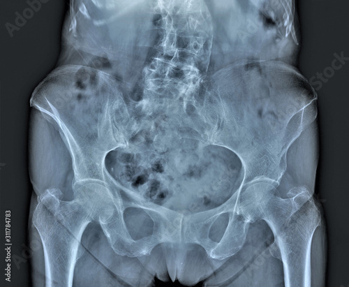 x-ray of the lumbar spine, pelvic bones, sacrum, hip joints
