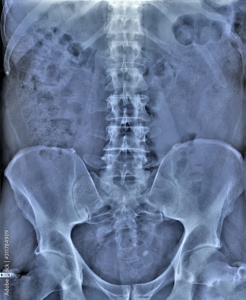 x-ray of the abdominal cavity and pelvis in direct projection, medical research,urography x-ray of the abdominal cavity and pelvis in direct projection, medical research,urography