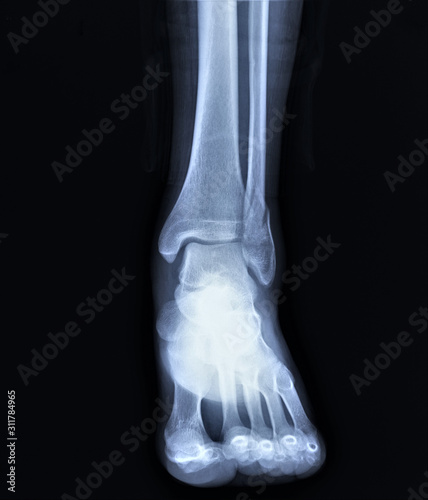 radiograph of the ankle joint  with a fracture of the outer ankle without displacement  traumatology  medical diagnostics