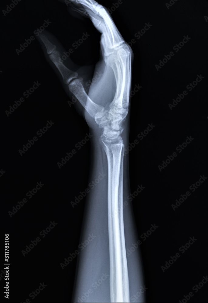 x ray of and wrist bones, traumatology and orthopedics x ray of and wrist bones, traumatology and orthopedics