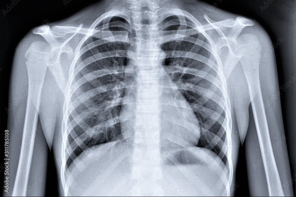 normal radiography of chest organs in direct projection, traumatology