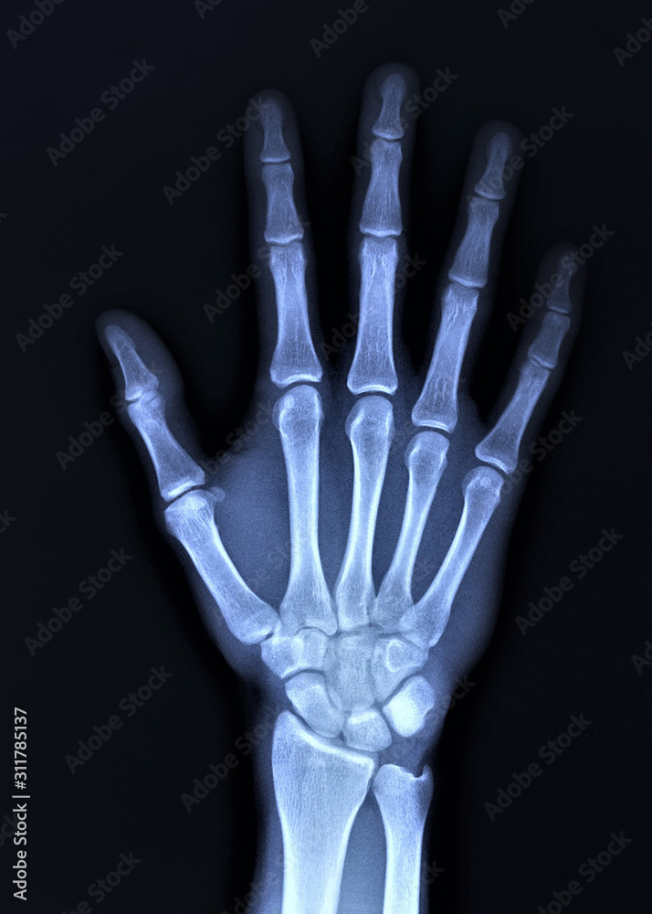 x-ray of hand bones, diagnosis of diseases x-ray of hand bones, diagnosis of diseases