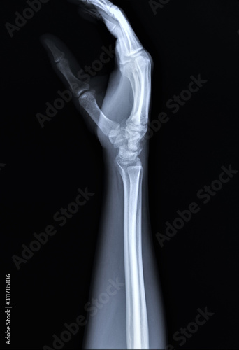 x ray of and wrist bones, traumatology and orthopedics
