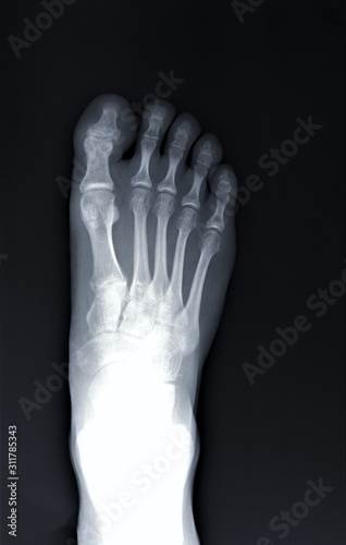 normal radiography of the foot, medical diagnostics, Traumatology and orthopedics, rheumatology