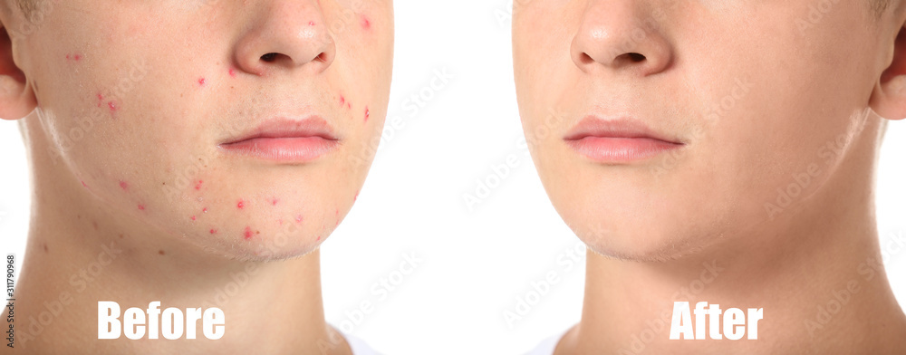 Teenage boy before and after acne treatment on white background Stock ...