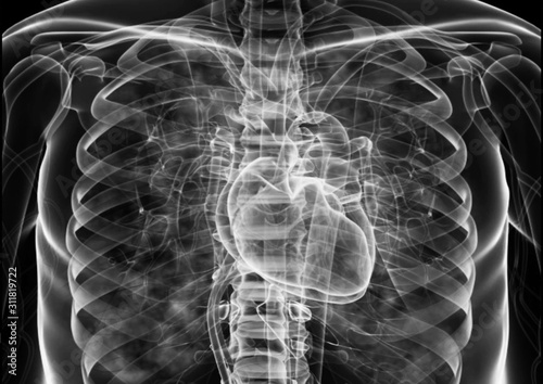 Medical flim chest x-ray body  heart and   both lung.concept MRI use diagnosis disease myocadium infraction (MI) and physiology lung diease. and point red on apex heart in flim.