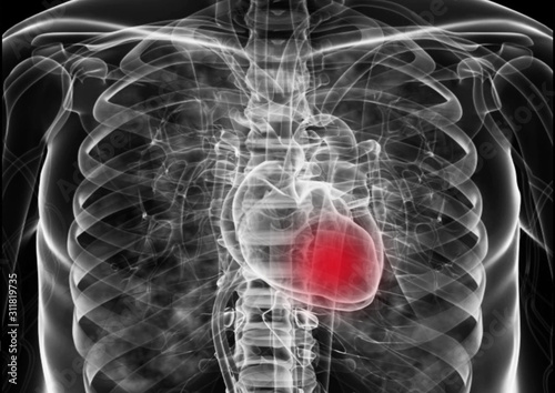  Medical flim chest x-ray body  heart and   both lung.concept MRI use diagnosis disease myocadium infraction (MI) and physiology lung diease. and point red on apex heart in flim.