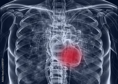  Medical flim chest x-ray body  heart and   both lung.concept MRI use diagnosis disease myocadium infraction (MI) and physiology lung diease. and point red on apex heart in flim.