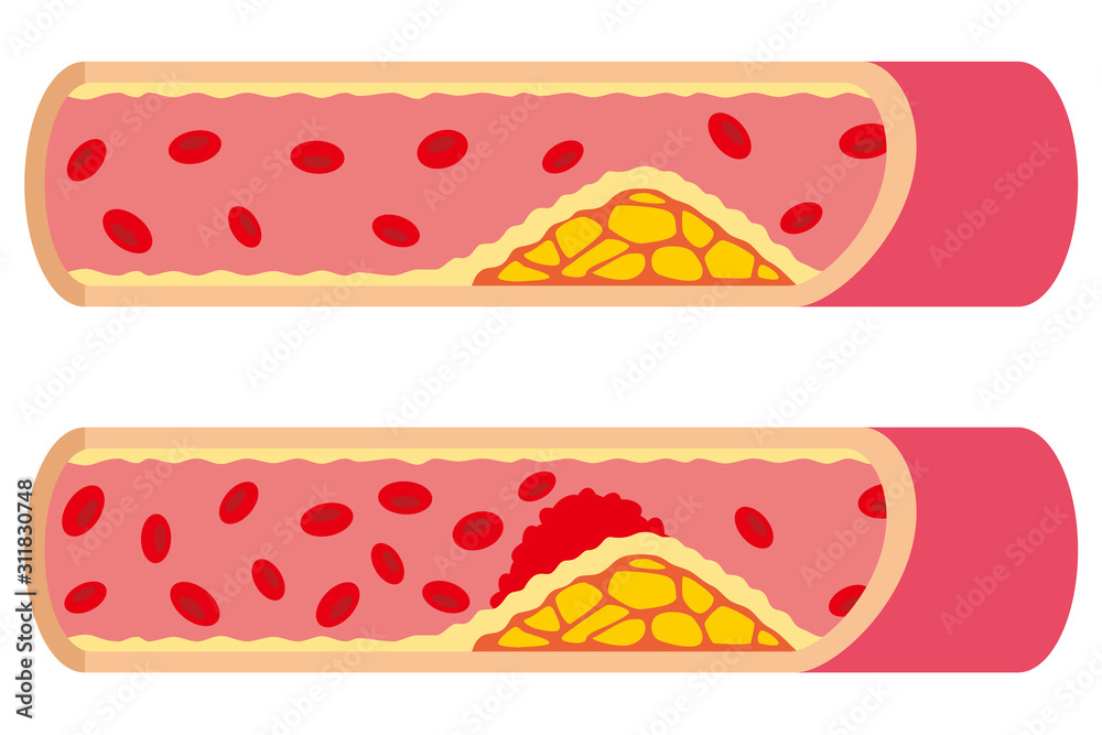 動脈硬化 血管 Stock イラスト Adobe Stock