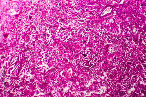 Kidney cancer, light micrograph, photo under microscope