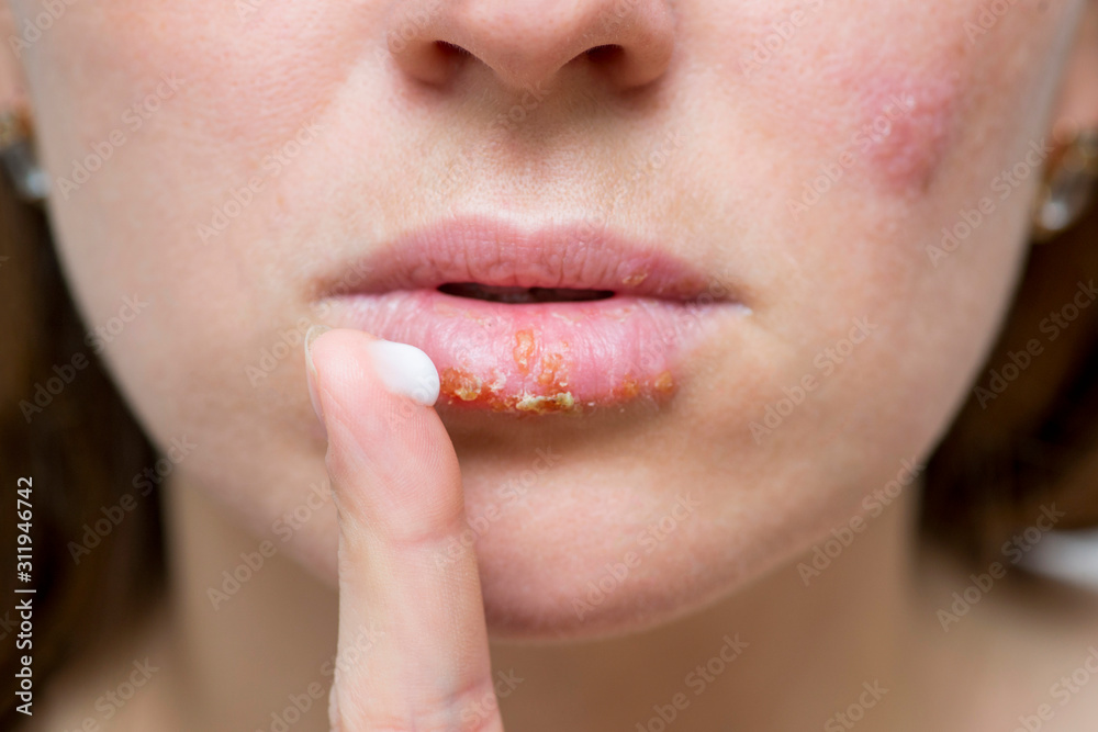 Naklejka premium Part of a young woman's face with a virus herpes on lips, treatment with ointment. Young woman with cold sore applying cream onto lips