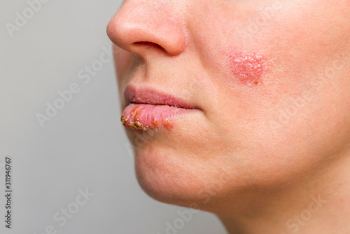 Closeup of a common cold sore virus herpes. Part of a young woman's face  with a virus herpes on lips Stock Photo | Adobe Stock