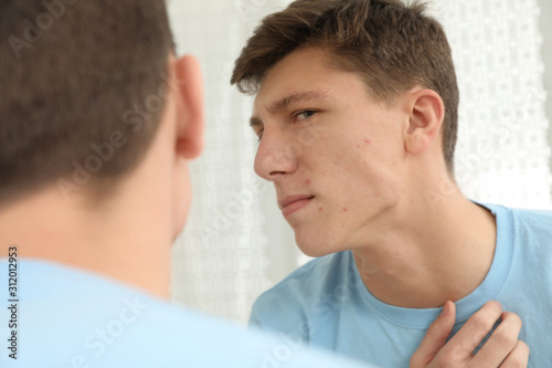 Teen guy with acne problem near mirror indoors