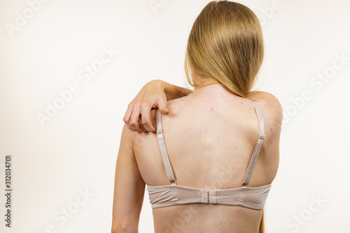 Woman with skin problem acne on back