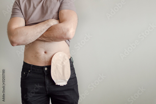 Front view on colostomy bag attached to man patient, medical theme. Selective focus on skin color ostomy pouch close-up. Colon cancer surgery treatment. photo