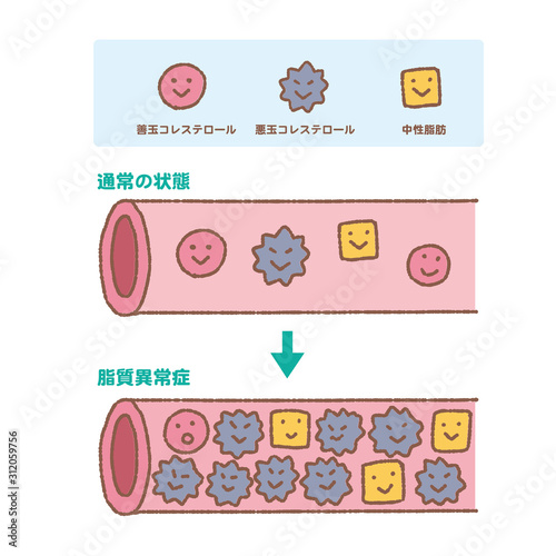 コレステロール　中性脂肪　善玉　悪玉　動脈硬化　イラスト