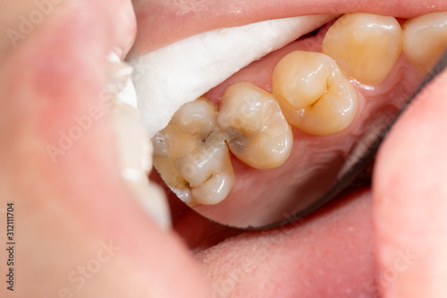 Caries and tooth disease. Filling with a dental composite photopolymer material using Rubber Dam. The concept of dental treatment in the dental clinic