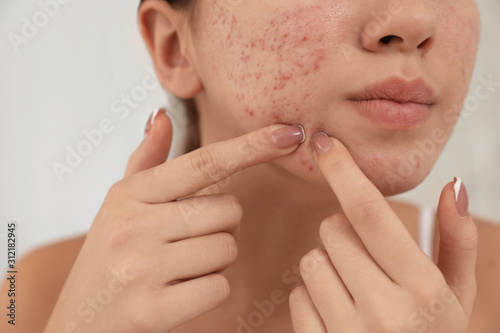 Teen girl with acne problem squeezing pimple on her face, closeup photo