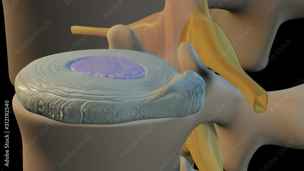 Bulging Disc