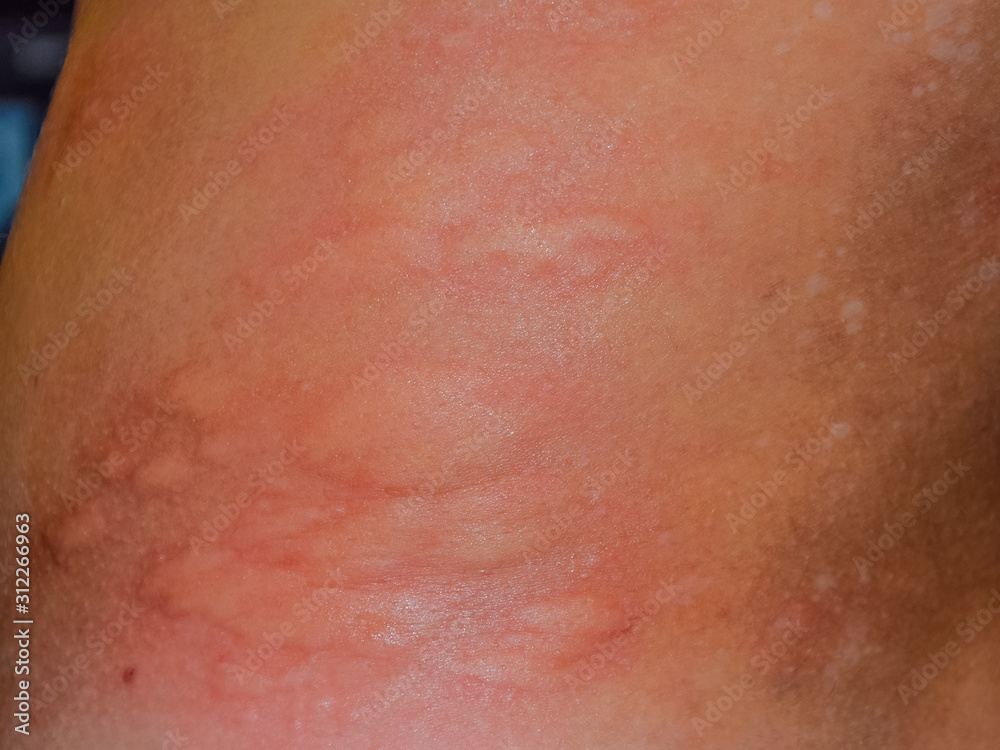 Allergy skin back and sides. Allergic reactions on the skin in the form of swelling and redness Allergy skin back and sides. Allergic reactions on the skin in the form of swelling and redness