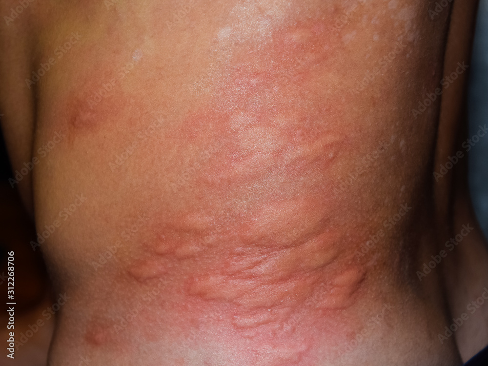 Allergy skin back and sides. Allergic reactions on the skin in the form of swelling and redness Allergy skin back and sides. Allergic reactions on the skin in the form of swelling and redness